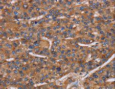 NCSTN / Nicastrin Antibody - Immunohistochemistry of paraffin-embedded Human liver cancer using NCSTN Polyclonal Antibody at dilution of 1:50.