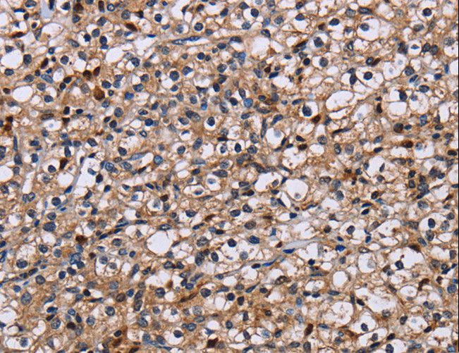NCSTN / Nicastrin Antibody - Immunohistochemistry of paraffin-embedded Human prostate cancer using NCSTN Polyclonal Antibody at dilution of 1:50.