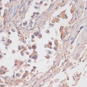 NCSTN / Nicastrin Antibody - Immunohistochemistry of paraffin-embedded Human lung cancer using NCSTN Polyclonal Antibody at dilution of 1:100 (40x lens).