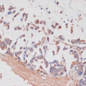NCSTN / Nicastrin Antibody - Immunohistochemistry of paraffin-embedded Human gastric cancer using NCSTN Polyclonal Antibody at dilution of 1:100 (40x lens).