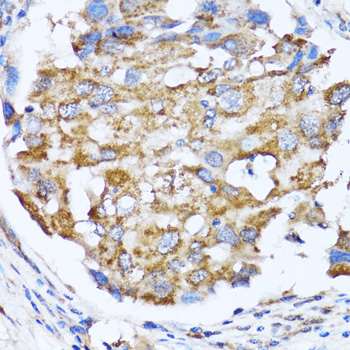 NDE1 Antibody - Immunohistochemistry of paraffin-embedded human breast cancer tissue.