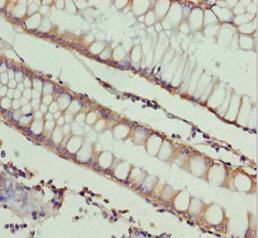 NDE1 Antibody - Immunohistochemistry of paraffin-embedded human colon cancer at dilution 1:100