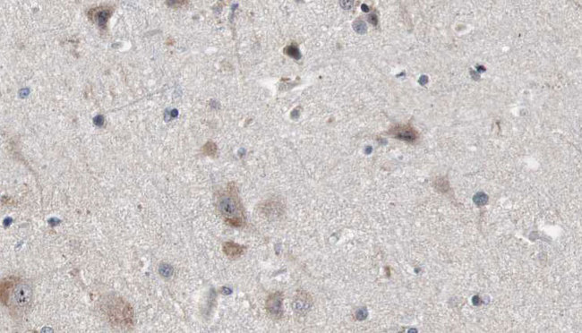 NDE1 Antibody - 1:100 staining human brain carcinoma tissue by IHC-P. The sample was formaldehyde fixed and a heat mediated antigen retrieval step in citrate buffer was performed. The sample was then blocked and incubated with the antibody for 1.5 hours at 22°C. An HRP conjugated goat anti-rabbit antibody was used as the secondary.