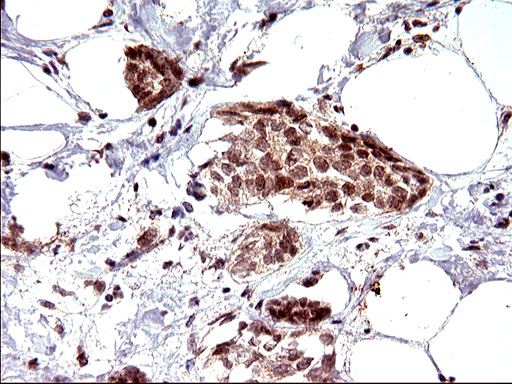 NDN / Necdin Antibody - IHC of paraffin-embedded Adenocarcinoma of Human breast tissue using anti-NDN mouse monoclonal antibody. (Heat-induced epitope retrieval by 10mM citric buffer, pH6.0, 120°C for 3min).