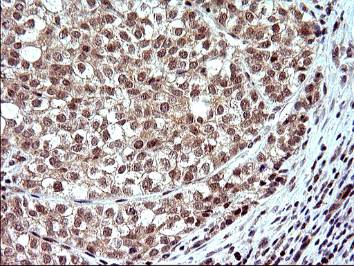 NDN / Necdin Antibody - IHC of paraffin-embedded Carcinoma of Human liver tissue using anti-NDN mouse monoclonal antibody. (Heat-induced epitope retrieval by 10mM citric buffer, pH6.0, 120°C for 3min).