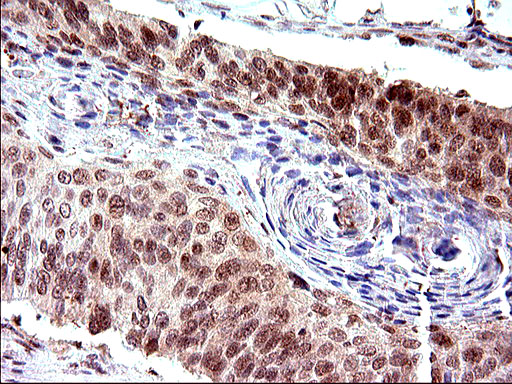 NDN / Necdin Antibody - IHC of paraffin-embedded Carcinoma of Human lung tissue using anti-NDN mouse monoclonal antibody. (Heat-induced epitope retrieval by 10mM citric buffer, pH6.0, 120°C for 3min).
