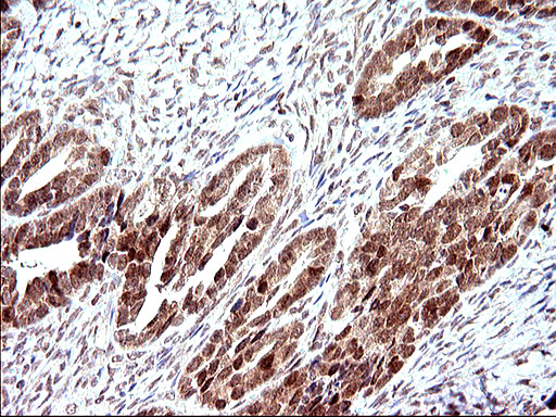NDN / Necdin Antibody - IHC of paraffin-embedded Adenocarcinoma of Human ovary tissue using anti-NDN mouse monoclonal antibody. (Heat-induced epitope retrieval by 10mM citric buffer, pH6.0, 120°C for 3min).