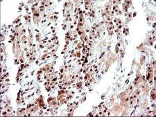 NDN / Necdin Antibody - IHC of paraffin-embedded Carcinoma of Human thyroid tissue using anti-NDN mouse monoclonal antibody. (Heat-induced epitope retrieval by 10mM citric buffer, pH6.0, 120°C for 3min).