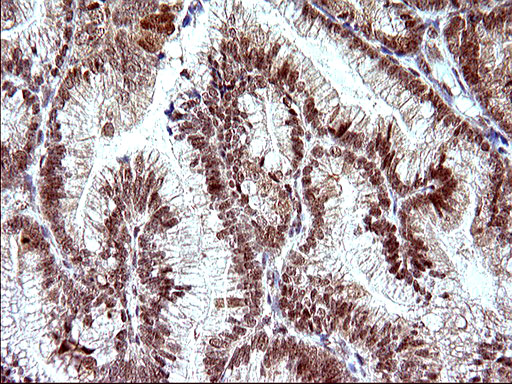 NDN / Necdin Antibody - IHC of paraffin-embedded Adenocarcinoma of Human endometrium tissue using anti-NDN mouse monoclonal antibody. (Heat-induced epitope retrieval by 10mM citric buffer, pH6.0, 120°C for 3min).