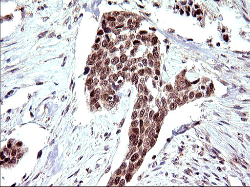 NDN / Necdin Antibody - IHC of paraffin-embedded Carcinoma of Human bladder tissue using anti-NDN mouse monoclonal antibody. (Heat-induced epitope retrieval by 10mM citric buffer, pH6.0, 120°C for 3min).