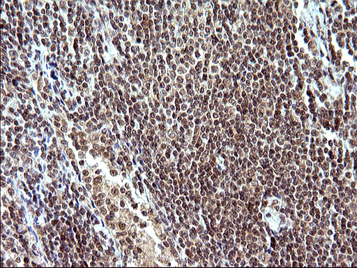 NDN / Necdin Antibody - IHC of paraffin-embedded Human lymphoma tissue using anti-NDN mouse monoclonal antibody. (Heat-induced epitope retrieval by 10mM citric buffer, pH6.0, 120°C for 3min).