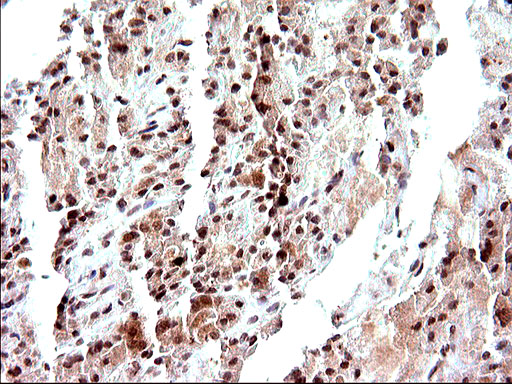 NDN / Necdin Antibody - IHC of paraffin-embedded Carcinoma of Human thyroid tissue using anti-NDN mouse monoclonal antibody. (Heat-induced epitope retrieval by 10mM citric buffer, pH6.0, 120°C for 3min).