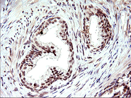 NDN / Necdin Antibody - IHC of paraffin-embedded Carcinoma of Human prostate tissue using anti-NDN mouse monoclonal antibody. (Heat-induced epitope retrieval by 10mM citric buffer, pH6.0, 120°C for 3min).