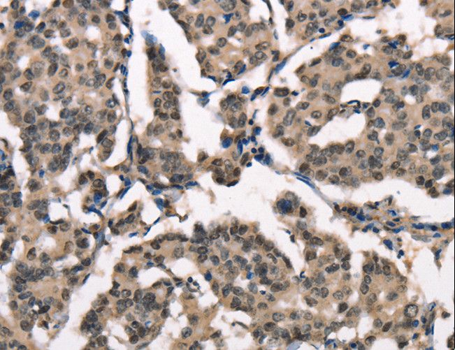 NDNL2 Antibody - Immunohistochemistry of paraffin-embedded Human breast cancer using NDNL2 Polyclonal Antibody at dilution of 1:40.
