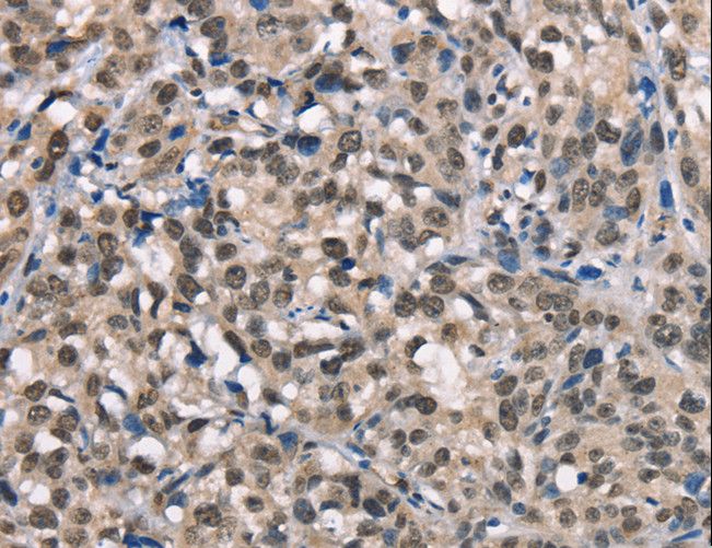 NDNL2 Antibody - Immunohistochemistry of paraffin-embedded Human esophagus cancer using NDNL2 Polyclonal Antibody at dilution of 1:40.