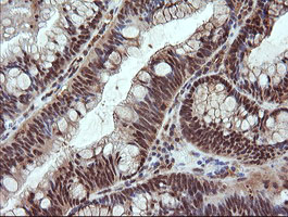 NDOR1 Antibody - IHC of paraffin-embedded Adenocarcinoma of Human colon tissue using anti-NDOR1 mouse monoclonal antibody. (Heat-induced epitope retrieval by 10mM citric buffer, pH6.0, 120°C for 3min).