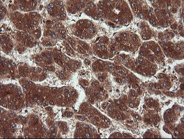 NDOR1 Antibody - IHC of paraffin-embedded Carcinoma of Human liver tissue using anti-NDOR1 mouse monoclonal antibody. (Heat-induced epitope retrieval by 10mM citric buffer, pH6.0, 120°C for 3min).