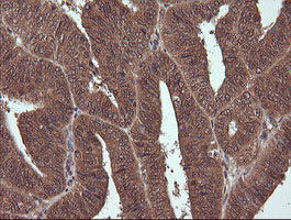 NDOR1 Antibody - IHC of paraffin-embedded Adenocarcinoma of Human endometrium tissue using anti-NDOR1 mouse monoclonal antibody. (Heat-induced epitope retrieval by 10mM citric buffer, pH6.0, 120°C for 3min).