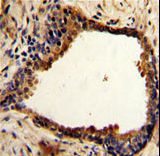 NDRG1 Antibody - Formalin-fixed and paraffin-embedded human prostate carcinoma with NDRG1 Antibody , which was peroxidase-conjugated to the secondary antibody, followed by DAB staining. This data demonstrates the use of this antibody for immunohistochemistry; clinical relevance has not been evaluated.