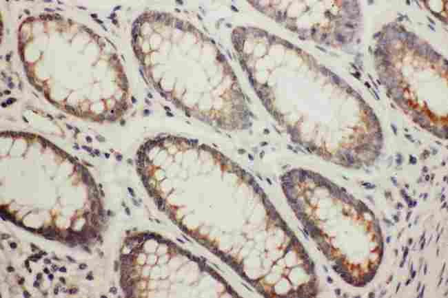 NDRG1 Antibody - Anti-NDRG1 antibody, IHC(P): Human Rectal Cancer Tissue