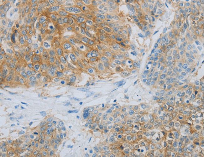 NDRG1 Antibody - Immunohistochemistry of paraffin-embedded Human esophagus cancer using NDRG1 Polyclonal Antibody at dilution of 1:70.