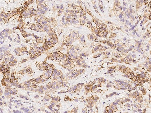 NDRG1 Antibody - Immunochemical staining of human NDRG1 in human breast carcinoma with rabbit polyclonal antibody at 1:5000 dilution, formalin-fixed paraffin embedded sections.