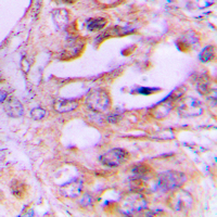 NDRG2 Antibody - Immunohistochemical analysis of NDRG2 staining in human lung cancer formalin fixed paraffin embedded tissue section. The section was pre-treated using heat mediated antigen retrieval with sodium citrate buffer (pH 6.0). The section was then incubated with the antibody at room temperature and detected using an HRP conjugated compact polymer system. DAB was used as the chromogen. The section was then counterstained with hematoxylin and mounted with DPX.