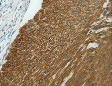 NDRG2 Antibody - Immunohistochemistry of paraffin-embedded Human ovarian cancer using NDRG2 Polyclonal Antibody at dilution of 1:40.