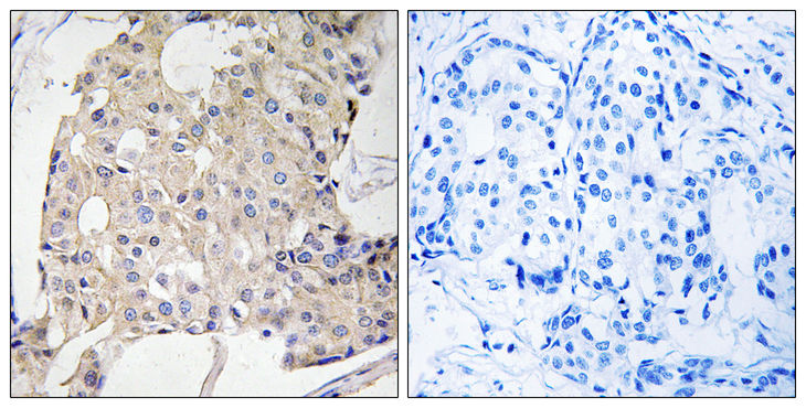 NDRG3 Antibody - Immunohistochemistry analysis of paraffin-embedded human breast carcinoma tissue, using NDRG3 Antibody. The picture on the right is blocked with the synthesized peptide.