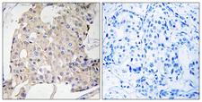 NDRG3 Antibody - Immunohistochemistry analysis of paraffin-embedded human breast carcinoma tissue, using NDRG3 Antibody. The picture on the right is blocked with the synthesized peptide.