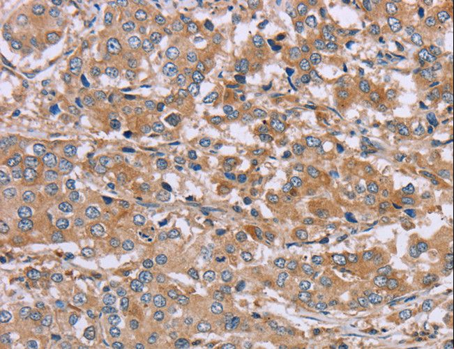 NDRG3 Antibody - Immunohistochemistry of paraffin-embedded Human liver cancer using NDRG3 Polyclonal Antibody at dilution of 1:40.