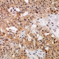 NDRG3 Antibody - Immunohistochemical analysis of NDRG3 staining in human breast cancer formalin fixed paraffin embedded tissue section. The section was pre-treated using heat mediated antigen retrieval with sodium citrate buffer (pH 6.0). The section was then incubated with the antibody at room temperature and detected using an HRP conjugated compact polymer system. DAB was used as the chromogen. The section was then counterstained with haematoxylin and mounted with DPX.