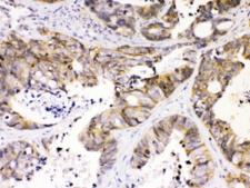 NDRG3 Antibody - IHC testing of FFPE human intestinal cancer tissue with NDRG3 antibody at 1ug/ml. Required HIER: steam section in pH6 citrate buffer for 20 min and allow to cool prior to testing.
