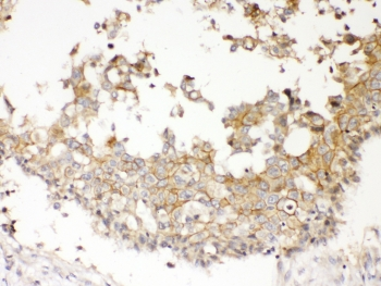 NDRG3 Antibody - IHC testing of FFPE human breast cancer tissue with NDRG3 antibody at 1ug/ml. Required HIER: steam section in pH6 citrate buffer for 20 min and allow to cool prior to testing.