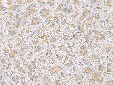 NDRG4 Antibody - Immunohistochemistry of paraffin-embedded Human liver cancer tissue  using NDRG4 Polyclonal Antibody at dilution of 1:45(×200)