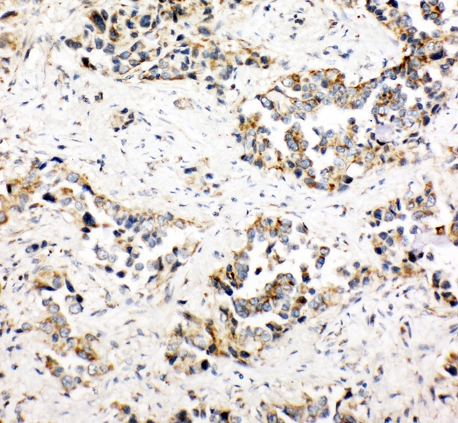 NDUFA1 Antibody - IHC analysis of NDUFA1 using anti-NDUFA1 antibody. NDUFA1 was detected in paraffin-embedded section of human lung cancer tissues. Heat mediated antigen retrieval was performed in citrate buffer (pH6, epitope retrieval solution) for 20 mins. The tissue section was blocked with 10% goat serum. The tissue section was then incubated with 1µg/ml rabbit anti-NDUFA1 Antibody overnight at 4°C. Biotinylated goat anti-rabbit IgG was used as secondary antibody and incubated for 30 minutes at 37°C. The tissue section was developed using Strepavidin-Biotin-Complex (SABC) with DAB as the chromogen.