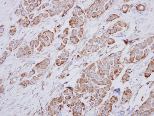 NDUFA10 Antibody - IHC of paraffin-embedded Breast ca using NDUFA10 antibody at 1:250 dilution.