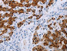 NDUFA12 / B17.2 Antibody - Immunohistochemistry of paraffin-embedded Human esophagus cancer using NDUFA12 Polyclonal Antibody at dilution of 1:50.