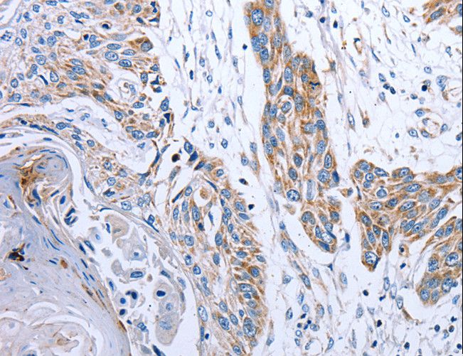 NDUFA12 / B17.2 Antibody - Immunohistochemistry of paraffin-embedded Human esophagus cancer using NDUFA12 Polyclonal Antibody at dilution of 1:50.