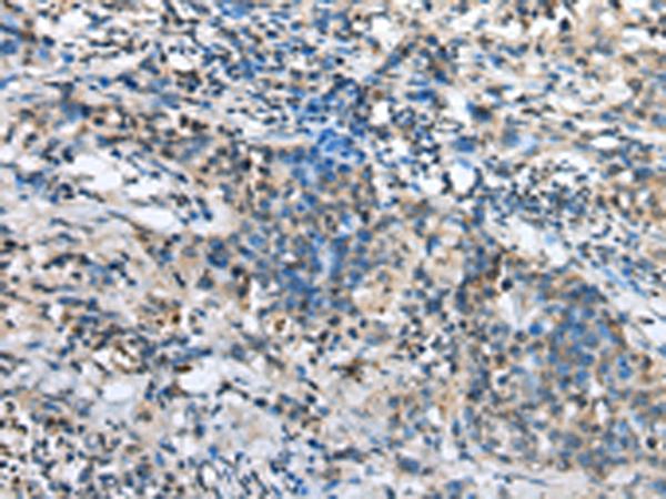 NDUFA12 / B17.2 Antibody - Immunohistochemistry of paraffin-embedded Human lung cancer tissue  using NDUFA12 Polyclonal Antibody at dilution of 1:30(×200)