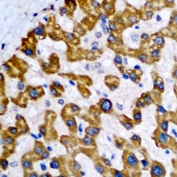 NDUFA2 Antibody - Immunohistochemical analysis of NDUFA2 staining in human liver cancer formalin fixed paraffin embedded tissue section. The section was pre-treated using heat mediated antigen retrieval with sodium citrate buffer (pH 6.0). The section was then incubated with the antibody at room temperature and detected using an HRP conjugated compact polymer system. DAB was used as the chromogen. The section was then counterstained with hematoxylin and mounted with DPX.