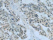 NDUFA2 Antibody - Immunohistochemistry of paraffin-embedded Human ovarian cancer tissue  using NDUFA2 Polyclonal Antibody at dilution of 1:40(×200)