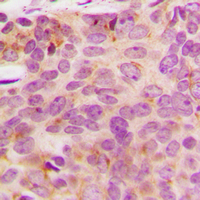 NDUFA3 / B9 Antibody - Immunohistochemical analysis of NDUFA3 staining in human breast cancer formalin fixed paraffin embedded tissue section. The section was pre-treated using heat mediated antigen retrieval with sodium citrate buffer (pH 6.0). The section was then incubated with the antibody at room temperature and detected using an HRP conjugated compact polymer system. DAB was used as the chromogen. The section was then counterstained with hematoxylin and mounted with DPX.