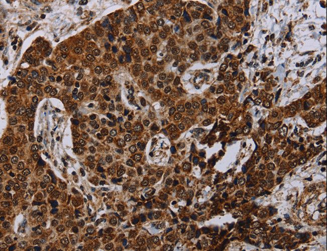 NDUFA4 Antibody - Immunohistochemistry of paraffin-embedded Human liver cancer using NDUFA4 Polyclonal Antibody at dilution of 1:40.