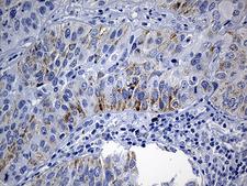 NDUFA4L2 Antibody - Immunohistochemical staining of paraffin-embedded Carcinoma of Human lung tissue using anti-NDUFA4L2 mouse monoclonal antibody. (Heat-induced epitope retrieval by 1mM EDTA in 10mM Tris buffer. (pH8.5) at 120°C for 3 min. (1:500)
