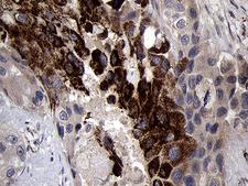 NDUFA4L2 Antibody - Immunohistochemical staining of paraffin-embedded Adenocarcinoma of Human breast tissue tissue using anti-NDUFA4L2 mouse monoclonal antibody. (Heat-induced epitope retrieval by 1mM EDTA in 10mM Tris buffer. (pH8.5) at 120°C for 3 min. (1:500)