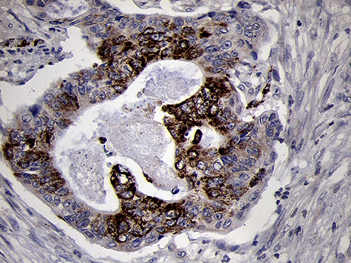 NDUFA4L2 Antibody - Immunohistochemical staining of paraffin-embedded Adenocarcinoma of Human colon tissue using anti-NDUFA4L2 mouse monoclonal antibody. (Heat-induced epitope retrieval by 1mM EDTA in 10mM Tris buffer. (pH8.5) at 120°C for 3 min. (1:500)