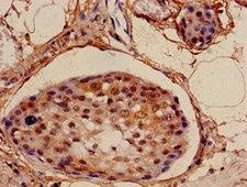 NDUFA4L2 Antibody - Immunohistochemistry image of paraffin-embedded human breast cancer at a dilution of 1:100