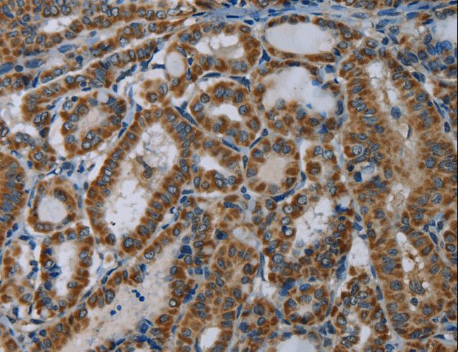 NDUFA5 Antibody - Immunohistochemistry of paraffin-embedded Human thyroid cancer using NDUFA5 Polyclonal Antibody at dilution of 1:60.