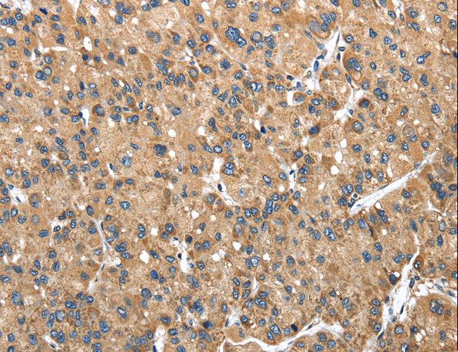 NDUFA5 Antibody - Immunohistochemistry of paraffin-embedded Human liver cancer using NDUFA5 Polyclonal Antibody at dilution of 1:40.